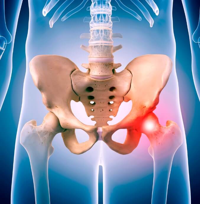 Untitled design (16) (1) remplacement de la hanche